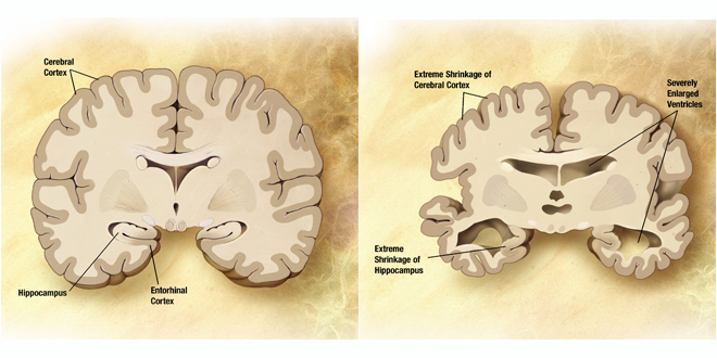 Alzheimers disease brain comparison