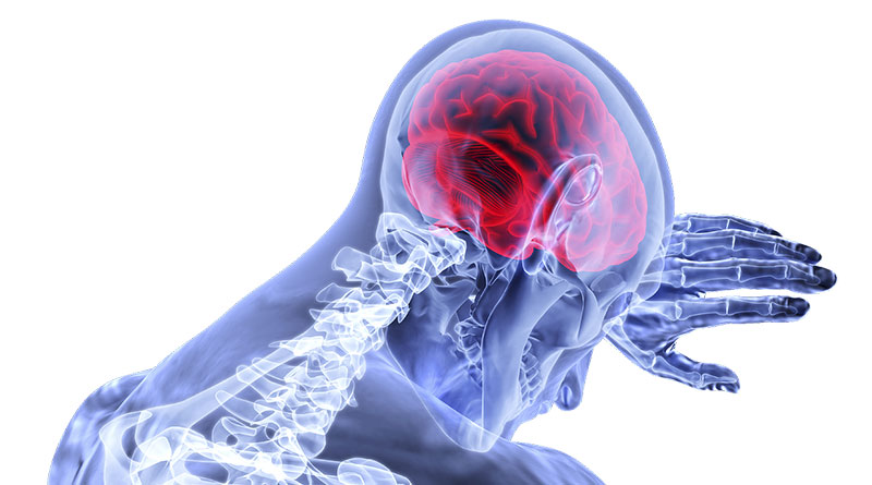 Alzheimer’s Protein Predicts Future Brain Shrinkage - Stroke