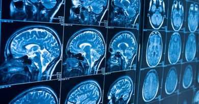 New Research Identifies Potential Target to Reduce Brain Inflammation in Alzheimer’s Disease