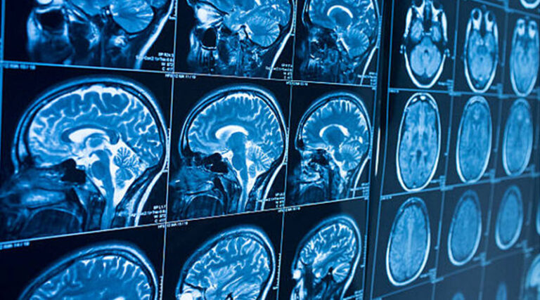 New Research Identifies Potential Target to Reduce Brain Inflammation ...